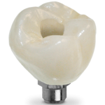 Screw-Retained-Posterior-Crown